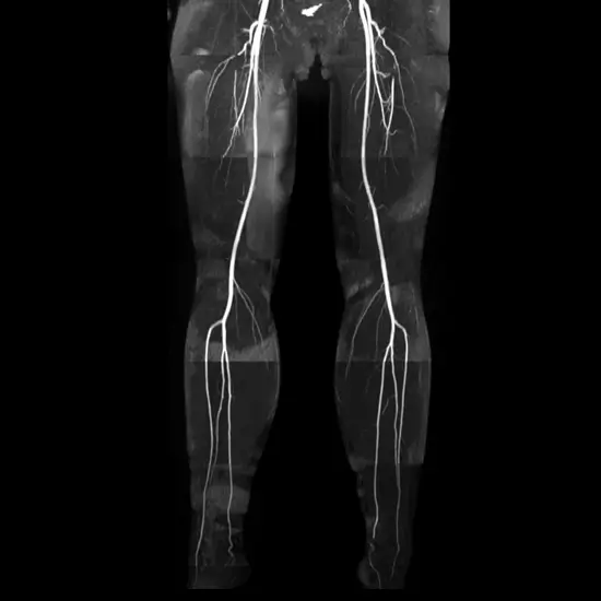 mri angiography of both lower limb